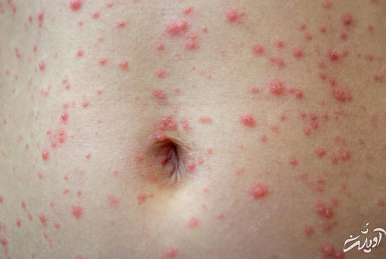 نشانه آنفلوانزای گوجه‌فرنگی